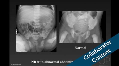 Abdominal Radiographic Diagnosis In The Newborn By George Taylor For