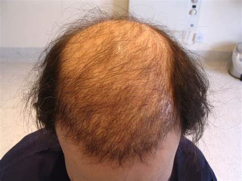 Completely Bald Hair Transplant Can It Be Done Wimpole Clinic