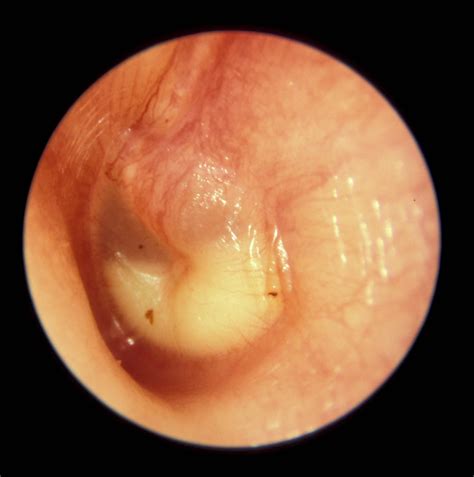 Otitis Media