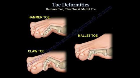 Toe Deformities Hammer Claw And Mallet Toes Everything You Need To