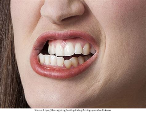 What Is Bruxism Or Teeth Grinding K Smile Dental Care