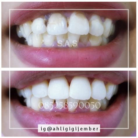We did not find results for: Foto Hasil dan Bongkar Tambalan / Perbaikan Gigi Berlubang Keropos dan Hitam! Versi Ahli Gigi ...