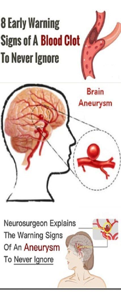 Neurosurgeon Explains The Warning Signs Of An Aneurysm To Never Ignore