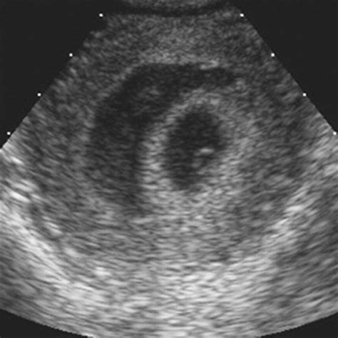 Prognosis Of Very Large First‐trimester Hematomas Leite 2006
