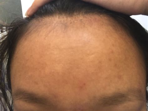 Small Bumps On Forehead General Acne Discussion