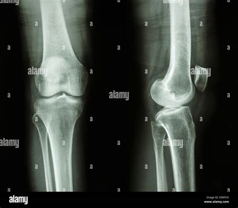 Normal Knee X Ray Stock Photos And Normal Knee X Ray Stock Images Alamy