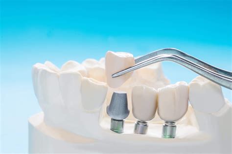 Dental Implant Restoration - Howard Family Dental