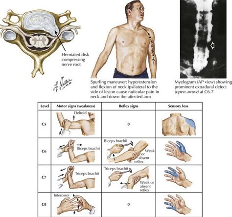 Cervical Radiculopathy Part 1 Clinical Presentation Rayner Amp Smale