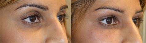 Cosmetic Filler Injection Eyelid Specialists Beverly Hills