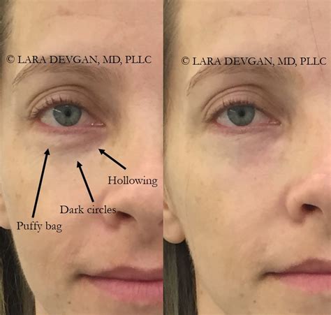 The Spectrum Of Eye Rejuvenation From Injections To