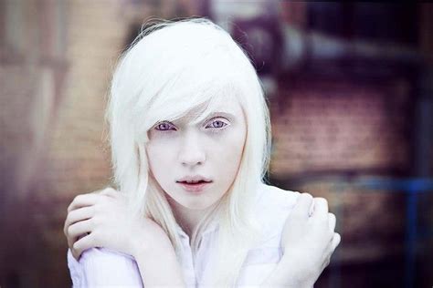 Albino Hastalığı Beştepe Bloggers