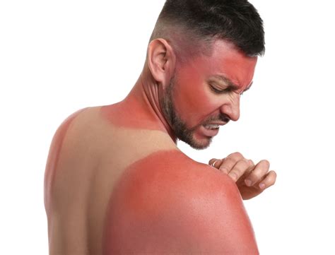 How To Treat Severe Sunburn Complete Care
