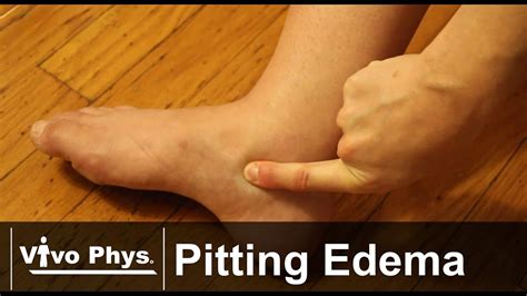 Edema In End Stage Cancer Una Otoole