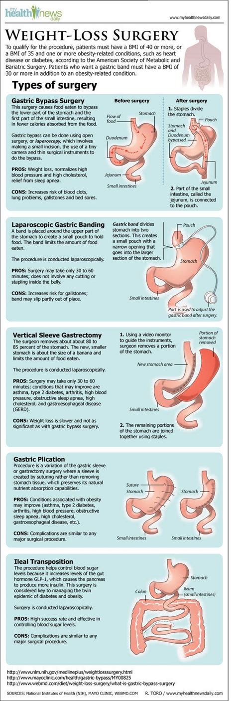 Pin On Weight Loss Surgery