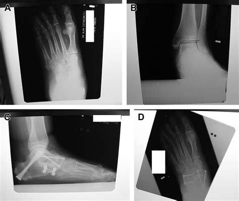 Triple Arthrodesis For Adult Acquired Flatfoot Clinics In Podiatric