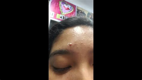 Juicy Pimple Popping Youtube