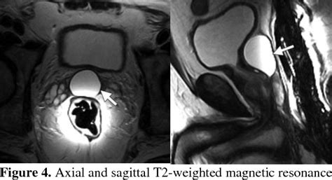 Figure 2 From Symptomatic Müllerian Duct Cyst In A Male Adult A Rare