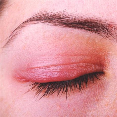 Whats Causing My Funky Eyelid Dry Eye Remedies Blepharitis