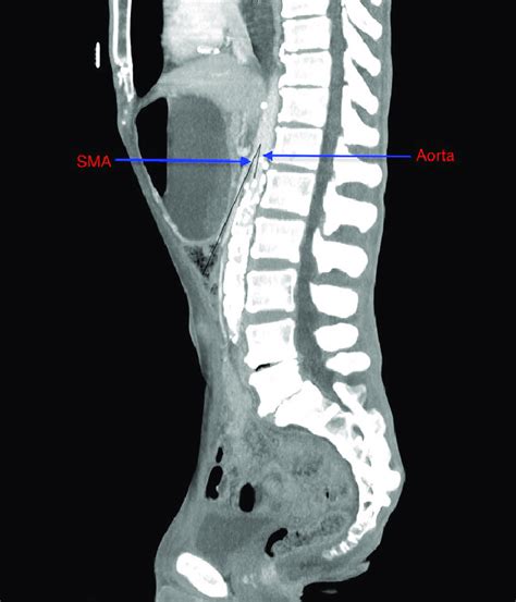 This Sagittal Section Of Ct Abdomen And Pelvis Shows Narrow Angle