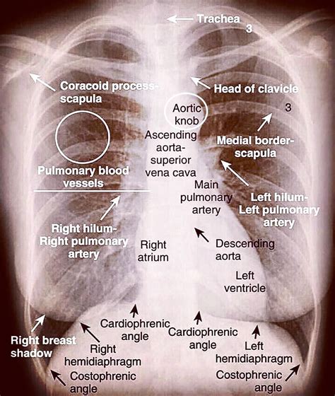 Normal Chest X Ray 👀 Visit Our Websites 👀 💻 Medical Institution