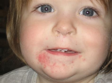 Eczema Around Mouth Toddler Dorothee Padraig South West Skin Health Care