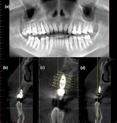 Figure 7 6 Month Post Operative Cbct A Panoramic View Shows