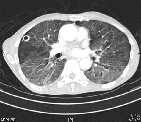 Figure Lung Abscess Computed Tomography Scan Statpearls Ncbi