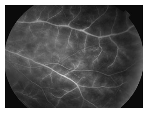 Fundus Photographs Top Late Phase Fluorescein Angiograms From Patient