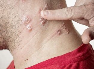 How long does your workout need to be? Shingles Symptoms