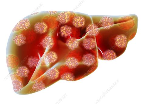 Human Liver With Hepatitis Viruses Stock Image F0121049 Science