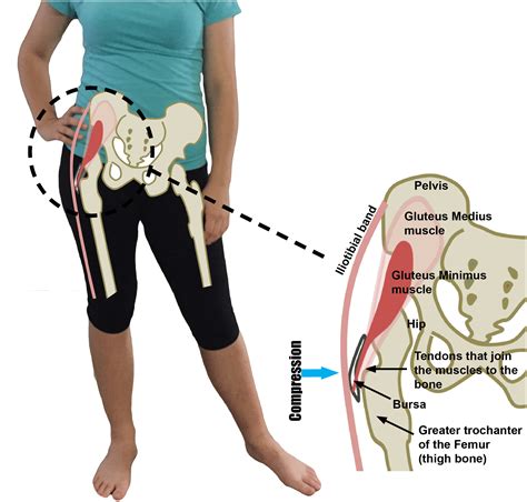 What Is Gluteal Tendinopathy And Hip Bursitis Differences And Causes