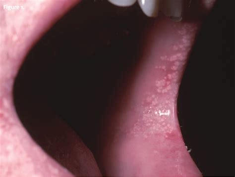 A 24 Year Old Male With Papules In His Mouth Page 2 Of 2 Journal Of