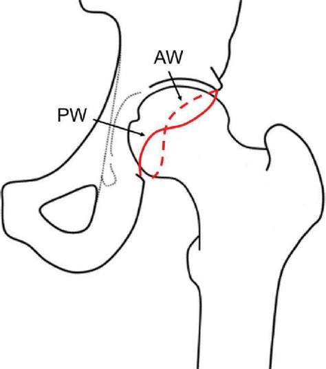 Figure A11 Positive Cross Over Sign Indicates That The Acetabular Wall