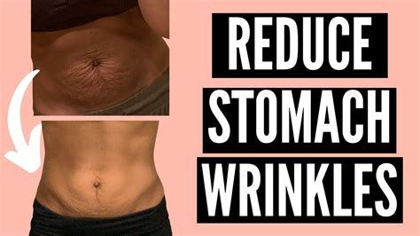 How To Get Rid Of Stomach Wrinkles Postpartum Naturally Not
