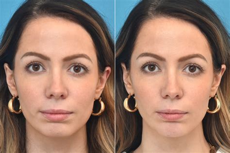 Injectable Fillers Photos Philadelphia Pa Patient 1368