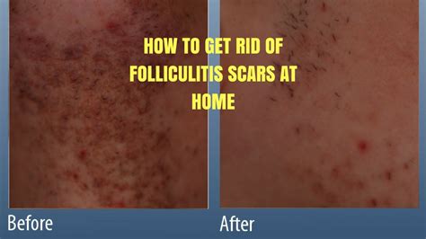How To Get Rid Of Folliculitis Scars At Home Youtube