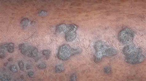 5 Best Homeopathic Medicines For Lichen Planus Homeopathic Specialist