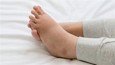 Doctors Explain The Causes Of Swollen Ankles How To Fix 6 Min Read