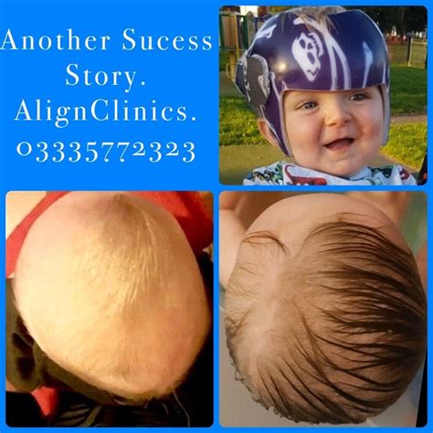 Plagiocephaly Brachycephaly Flat Head Syndrome Helmet Treatment For