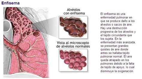 Enfisema Pulmonar S Ntomas Causas Tratamiento The Best Porn Website