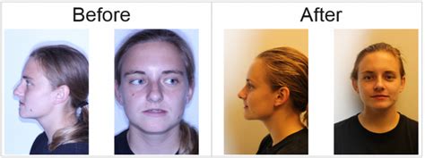 What Is Orthognathic Corrective Jaw Surgery Oral And Facial Surgeons