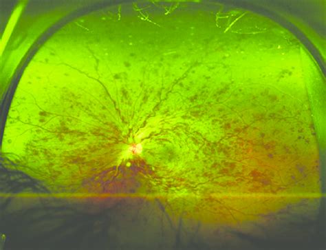 An Ultra Widefield Color Fundus Photo Of The Left Eye Of A 60 Year Old