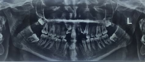 Non Syndromic Multiple Impacted Teeth Two Case Reports Biomedical