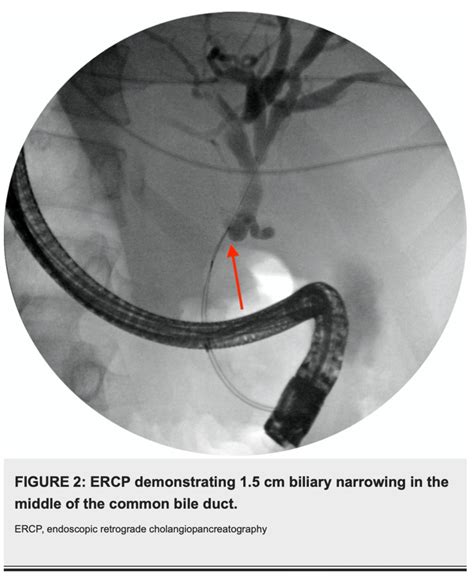 Ercp Demonstrating 15 Cm Biliary Narrowing In The Middle Of The Common
