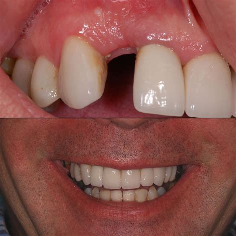 Dental Implants In Thames Ditton Within Easy Reach Of Surbiton
