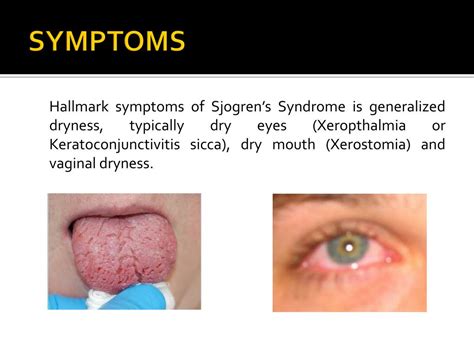 Ppt Sjogrens Syndrome Powerpoint Presentation Free Download Id