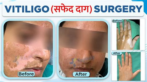 Vitiligo सफ़ेद दाग Surgery Safed Daag का इलाज सफेद दाग का इलाज