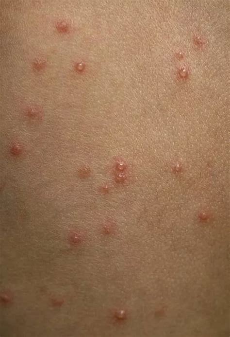 Chicken Pox Symptoms To Look Out For From Itchy Spots And Rash To Flu