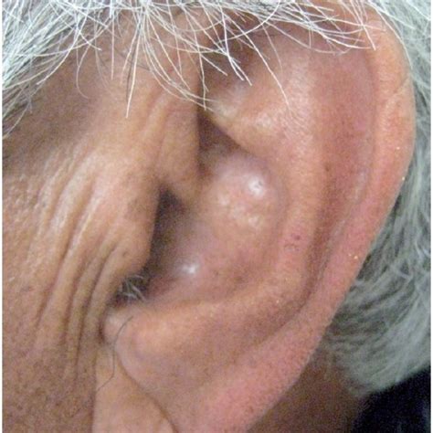 Number of diagonal branches was observed: The same patient with a somewhat less distinct diagonal ear lobe crease... | Download Scientific ...