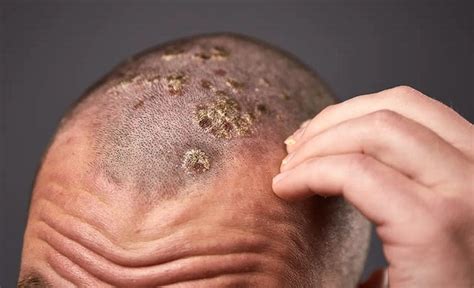 Scalp Psoriasis Its Symptoms Causes And Its Treatment Options